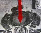 spinal-kanalstenose