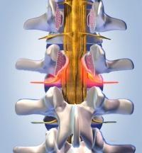 Spinalkanalstenose