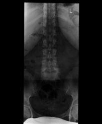 Spondylolisthese