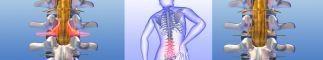 Spinalstenose