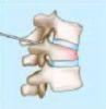 thumb_kyphoplastie